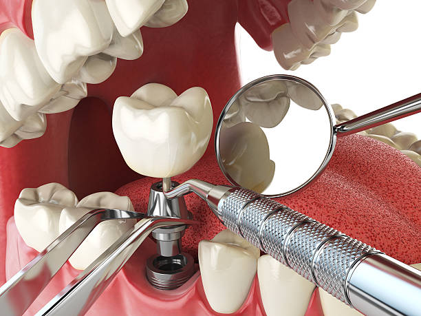 Best Broken or Cracked Tooth Emergency Dentist in Sunny Isles Beach, FL